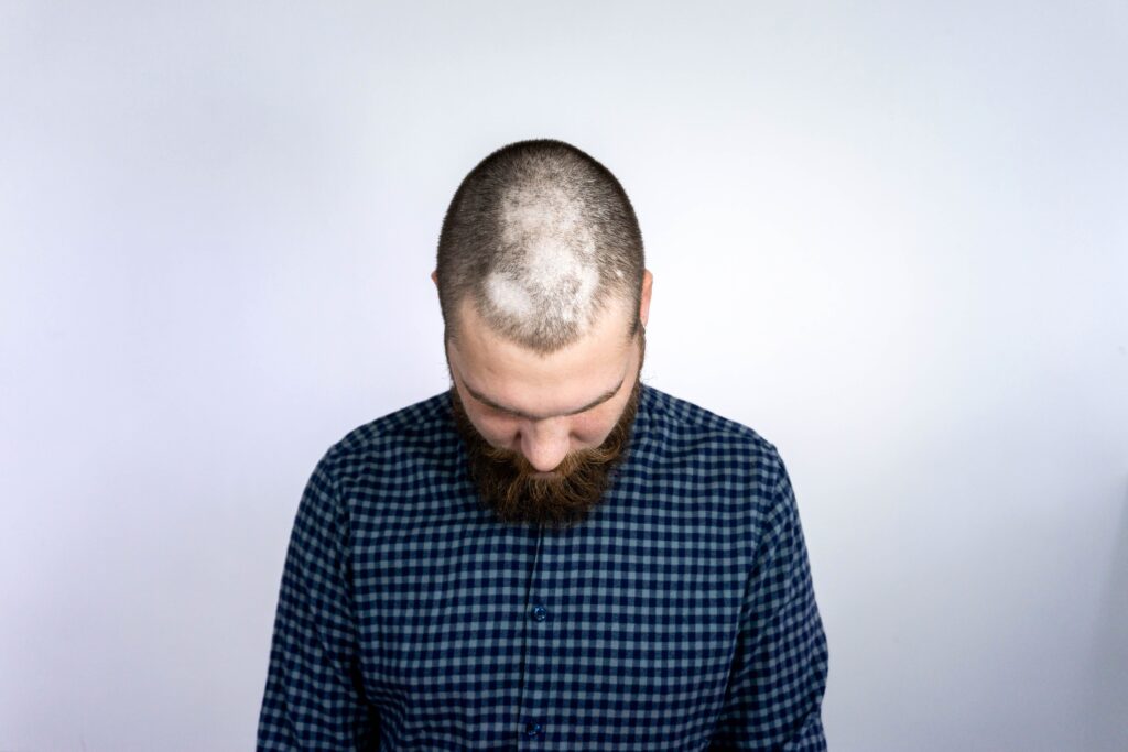 Homme présentant une perte de cheveux en plaques due à l’alopecia areata