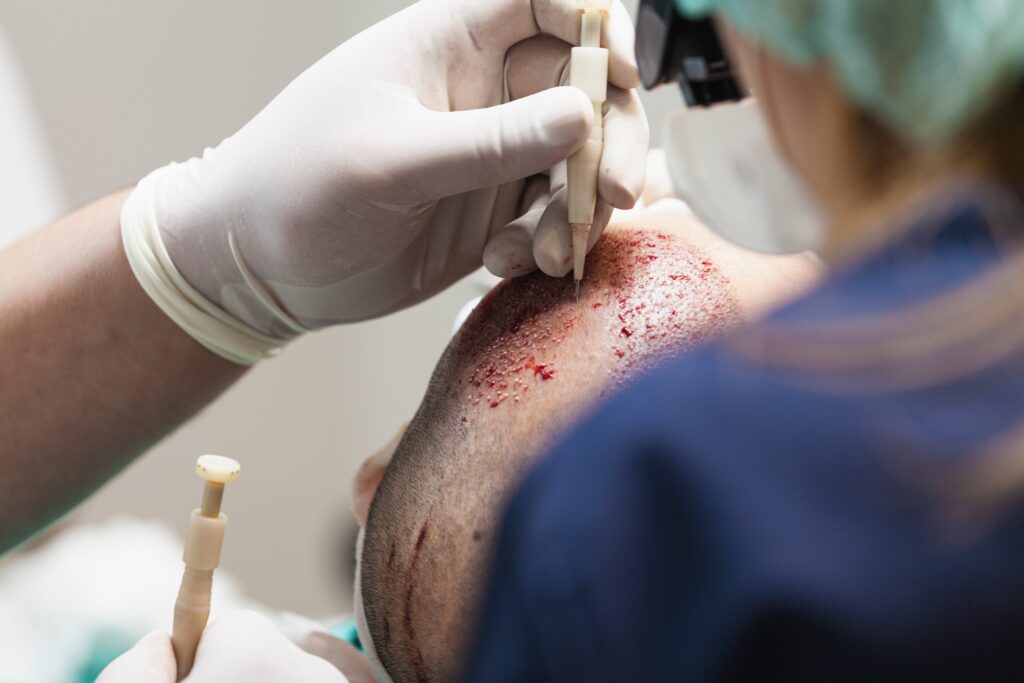 Photo d'implantation de greffons contre la perte de cheveux