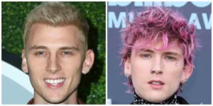 Before and after state of Machine Gun Kelly's hair transplant