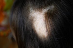 Plaque ronde de perte de cheveux typique d’une alopecia areata
