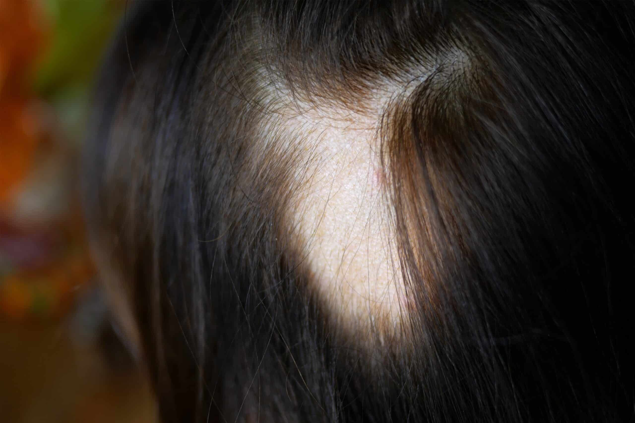 Plaque ronde de perte de cheveux typique d’une alopecia areata