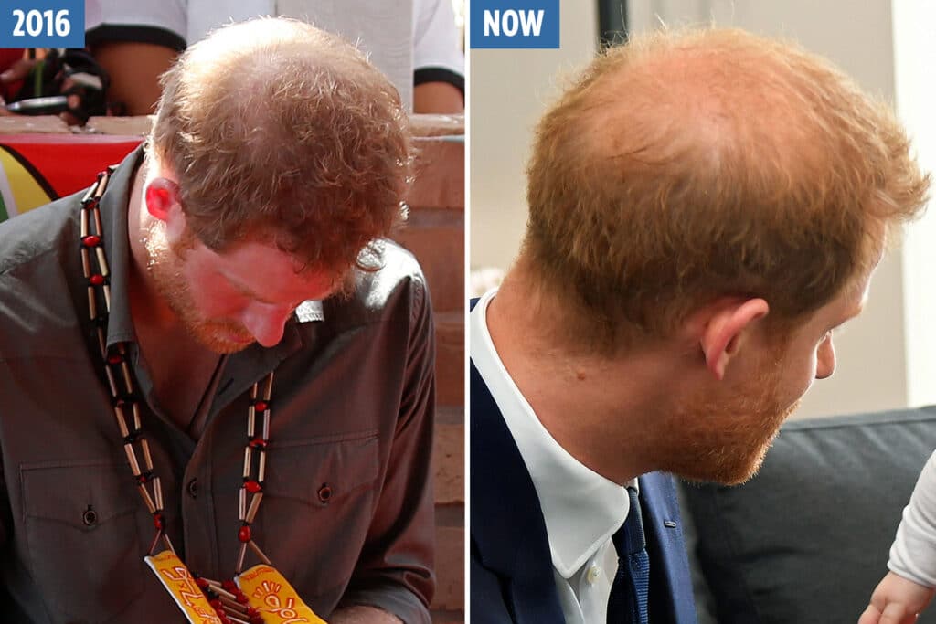 Prince Harry hair loss comparison from 2016 to now