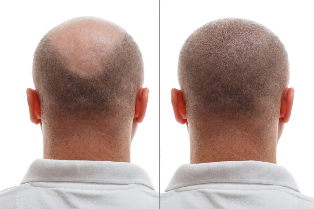 Voor- en nafoto van haarkroon na haartransplantatie na 3 maanden, met duidelijk herstel