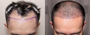 Vue rapprochée d’un cuir chevelu avant et après une greffe de cheveux