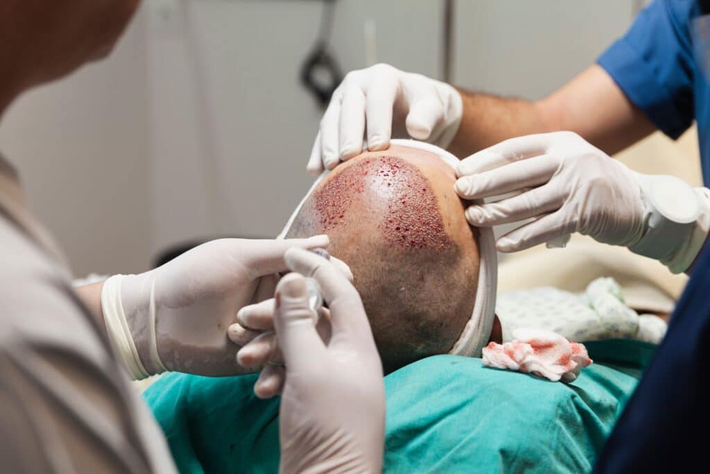 Photo of a hair transplant at a high quality clinic