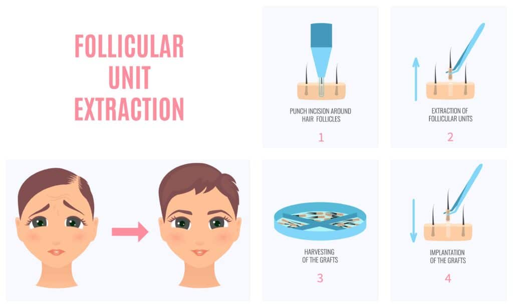 Illustration of the stages of a FUE procedure.