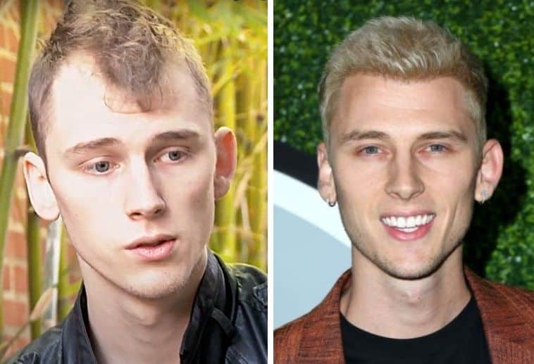 Machine Gun Kelly's hair has significantly improved in the after picture