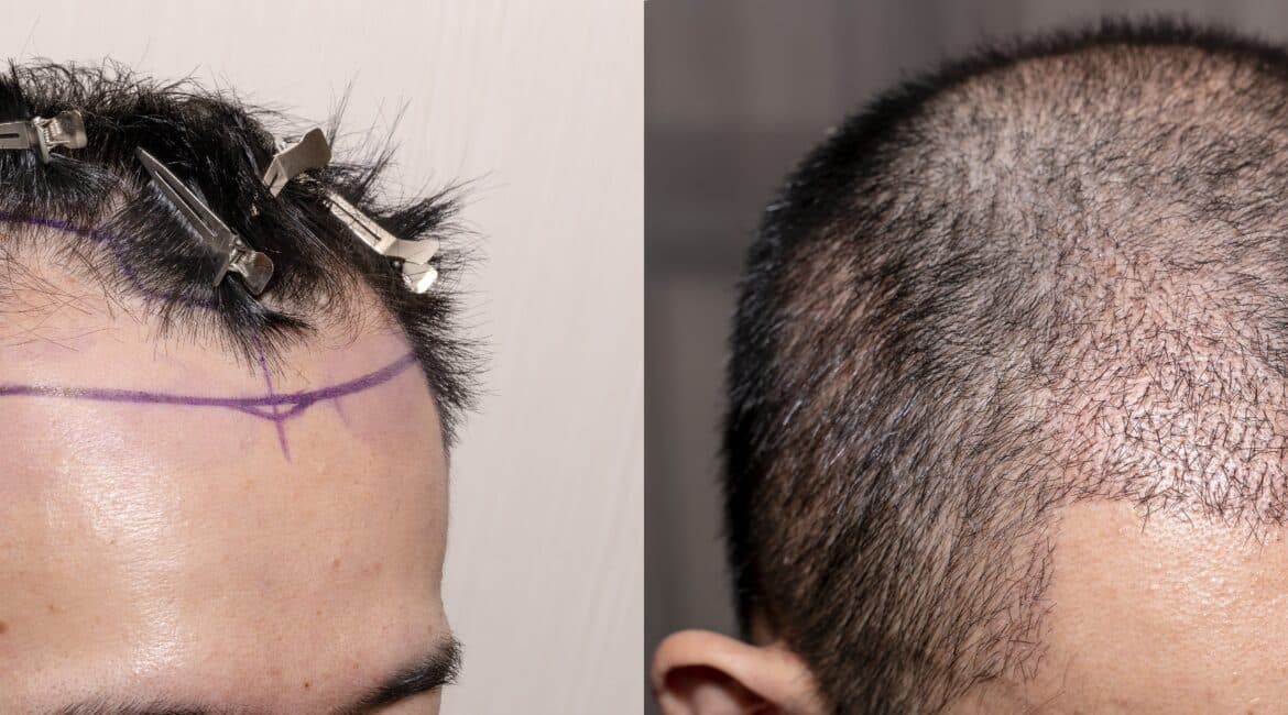 The hair transplant process delivers visible improvement in hairline and density
