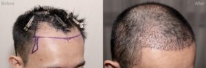 The hair transplant process delivers visible improvement in hairline and density