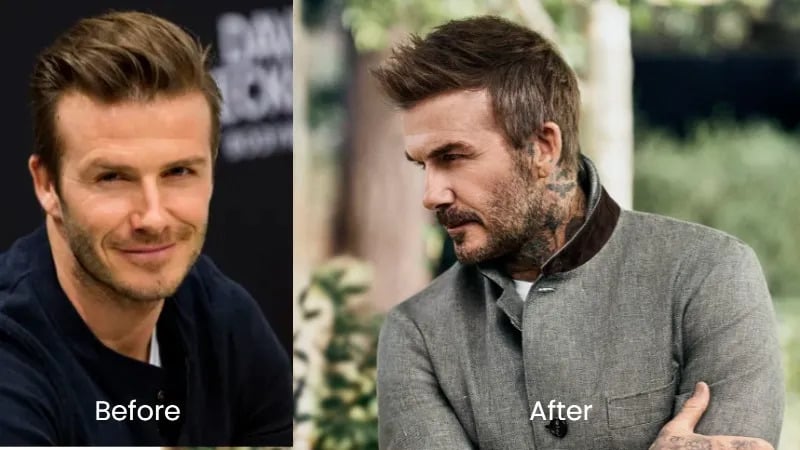 David Beckham before and after showing fuller hair, linked to David Beckham hair transplant