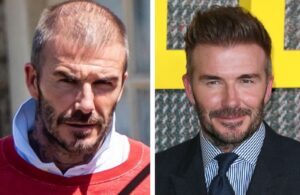 The visible difference in hair density adds to speculation about David Beckham hair transplant