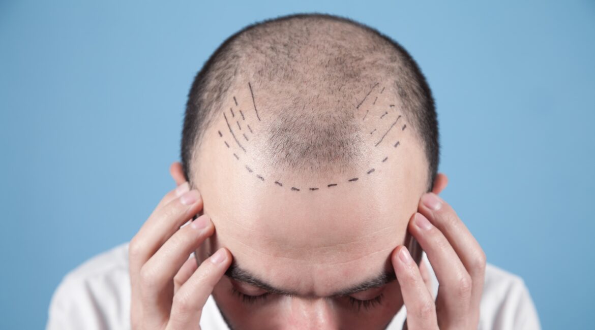 Patient with hairline design before Hair Transplant Consultation