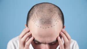 Patient with hairline design before Hair Transplant Consultation