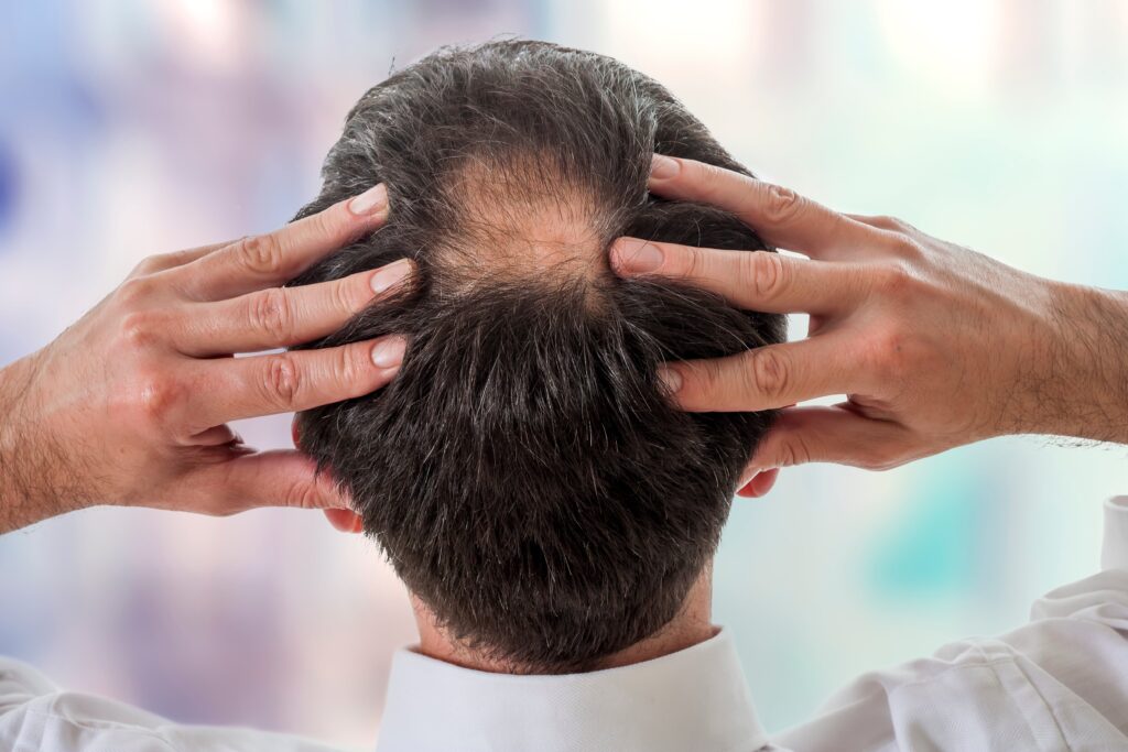 La tonsure cheveux est un signe fréquent d’alopécie androgénétique