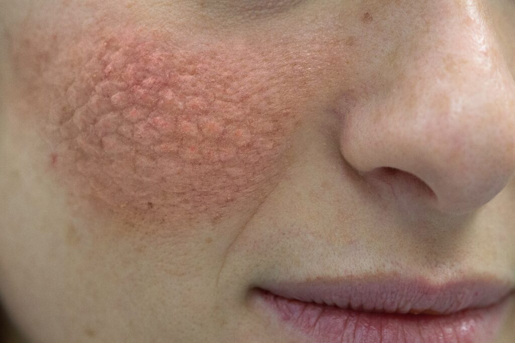 Éruption rouge sur la joue montrant un lupus cutané, souvent associé au lupus perte de cheveux.