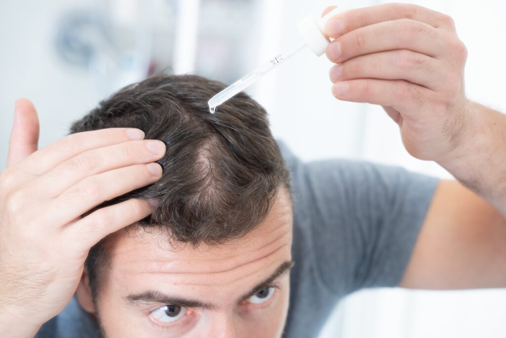 Man brengt vloeibaar middel aan op hoofdhuid met het beste haargroeimiddel