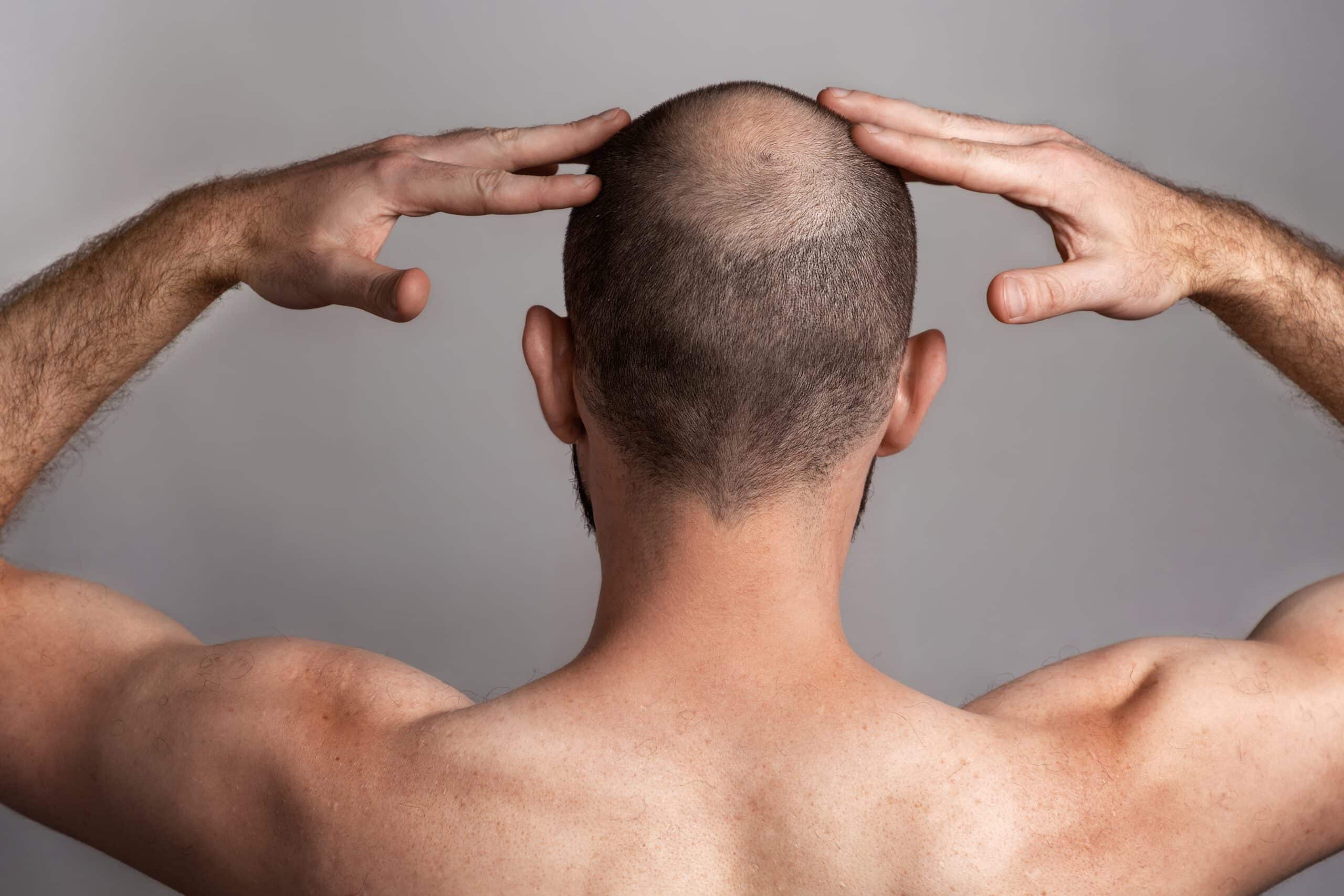 Exemple avancé de tonsure cheveux chez un homme