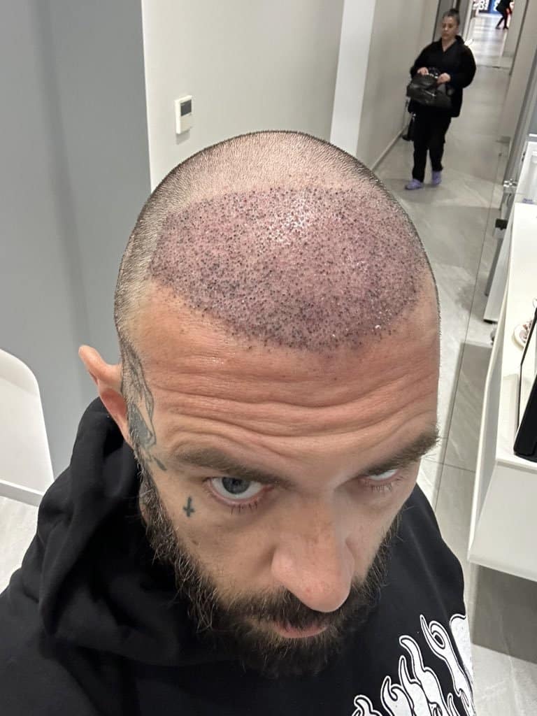 Photo of Adam22 after his hair transplant at Cosmedica Clinic