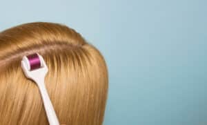 Foto di un dermaroller capelli sulla testa di una donna