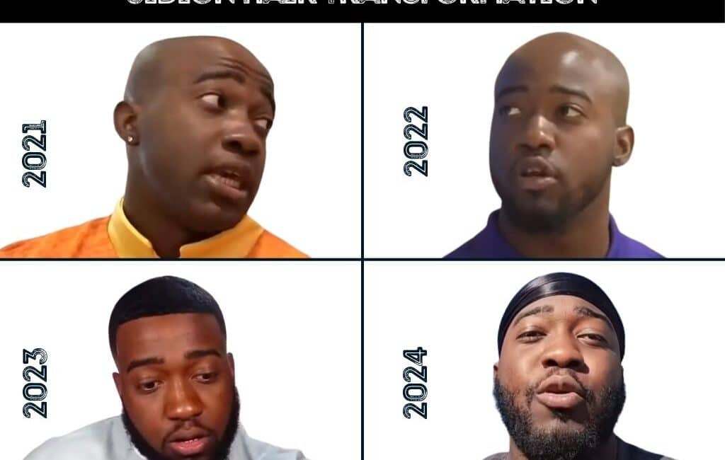 Pictures of Jidion hair transformation before and after a possible hair transplant