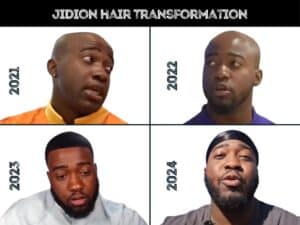 Pictures of Jidion hair transformation before and after a possible hair transplant