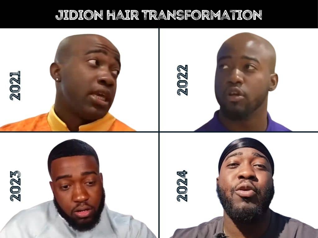 Pictures of Jidion hair transformation before and after a possible hair transplant
