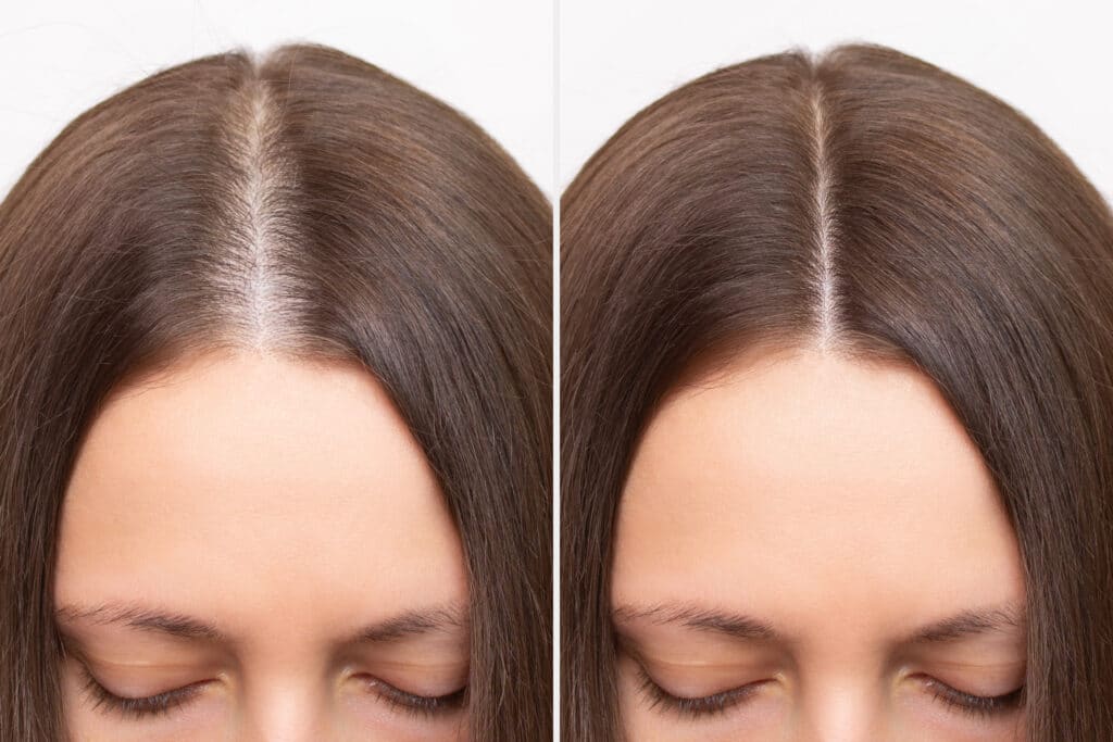 Donna prima e dopo il trapianto capelli lunghi