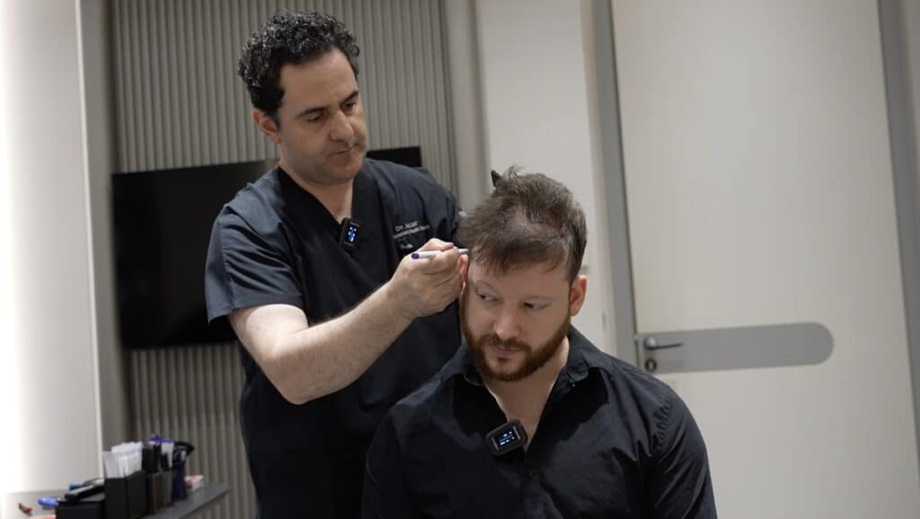Dr. Acar markiert bei der Haartransplantation Beratung den Spender