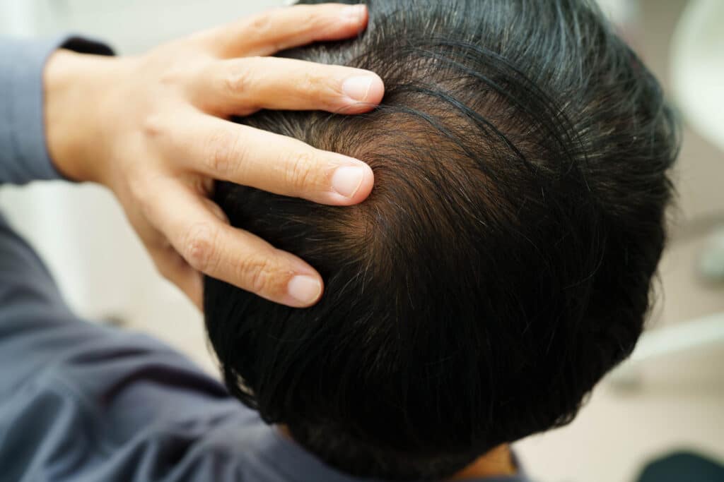 Hombre se toca el pelo con un problema de calvicie