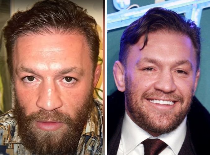 Did Conor McGregor have a hair transplant?