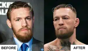 Conno McGregor Hair Transplant Before and After