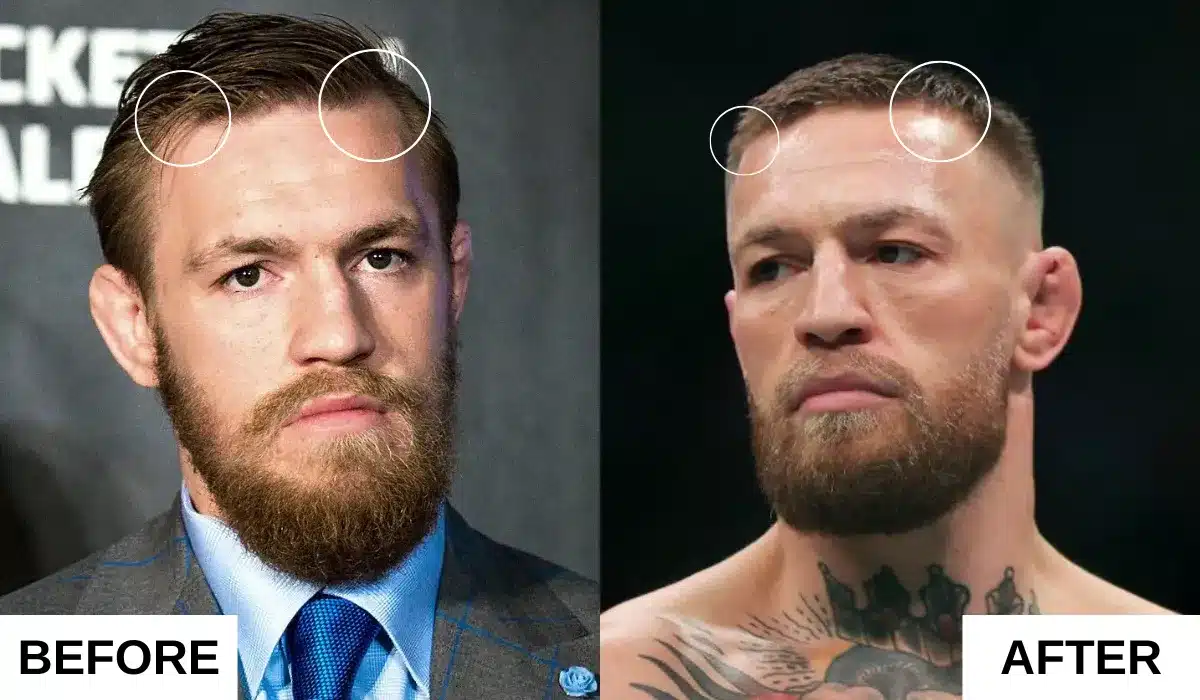 Conno McGregor Hair Transplant Before and After