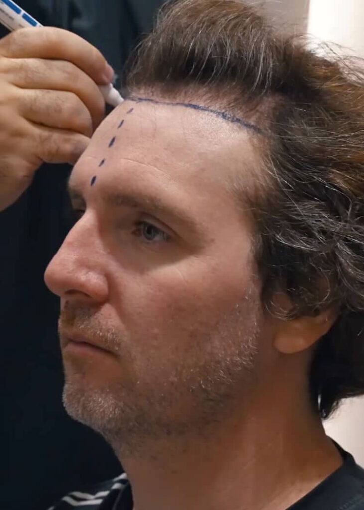 Inside Greg Lutzka's hair transplant at Cosmedica