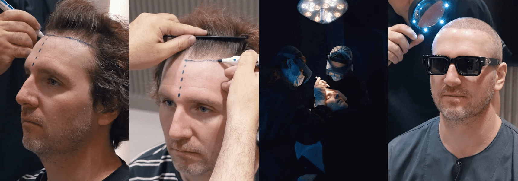 Greg Lutzka przeszedł zabieg przeszczepu włosów w Klinice Cosmedica.