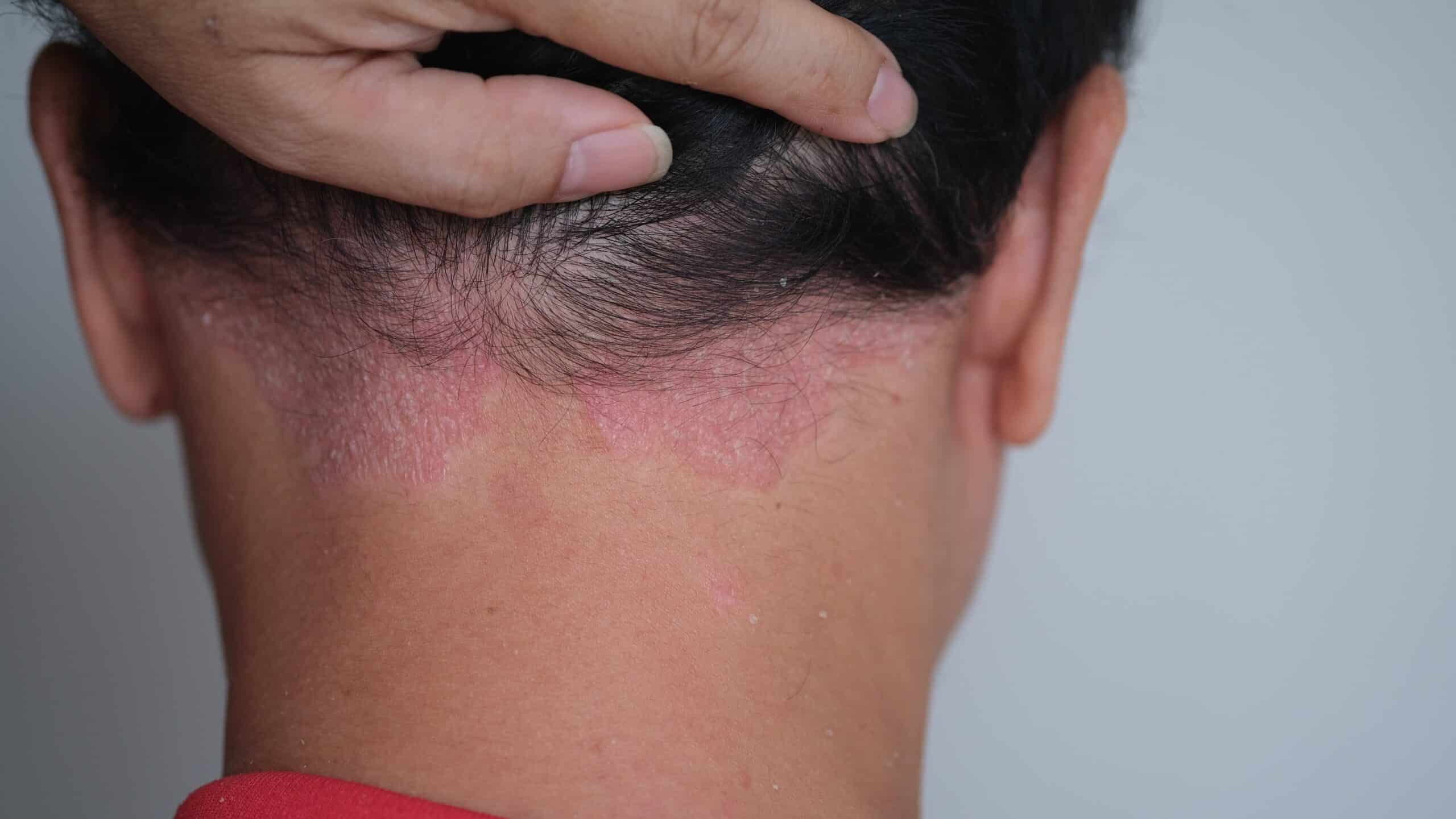 Le psoriasis du cuir chevelu doit être stabilisé avant toute greffe de cheveux