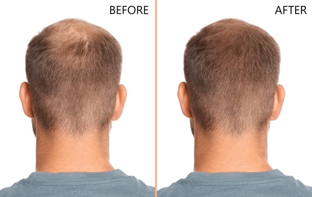 Crescita dei capelli di un uomo dopo il trapianto di capelli