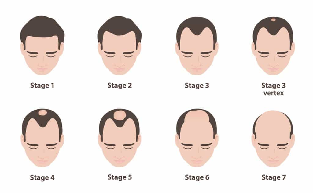 Image of the 7 stages of the norwood hamilton scale