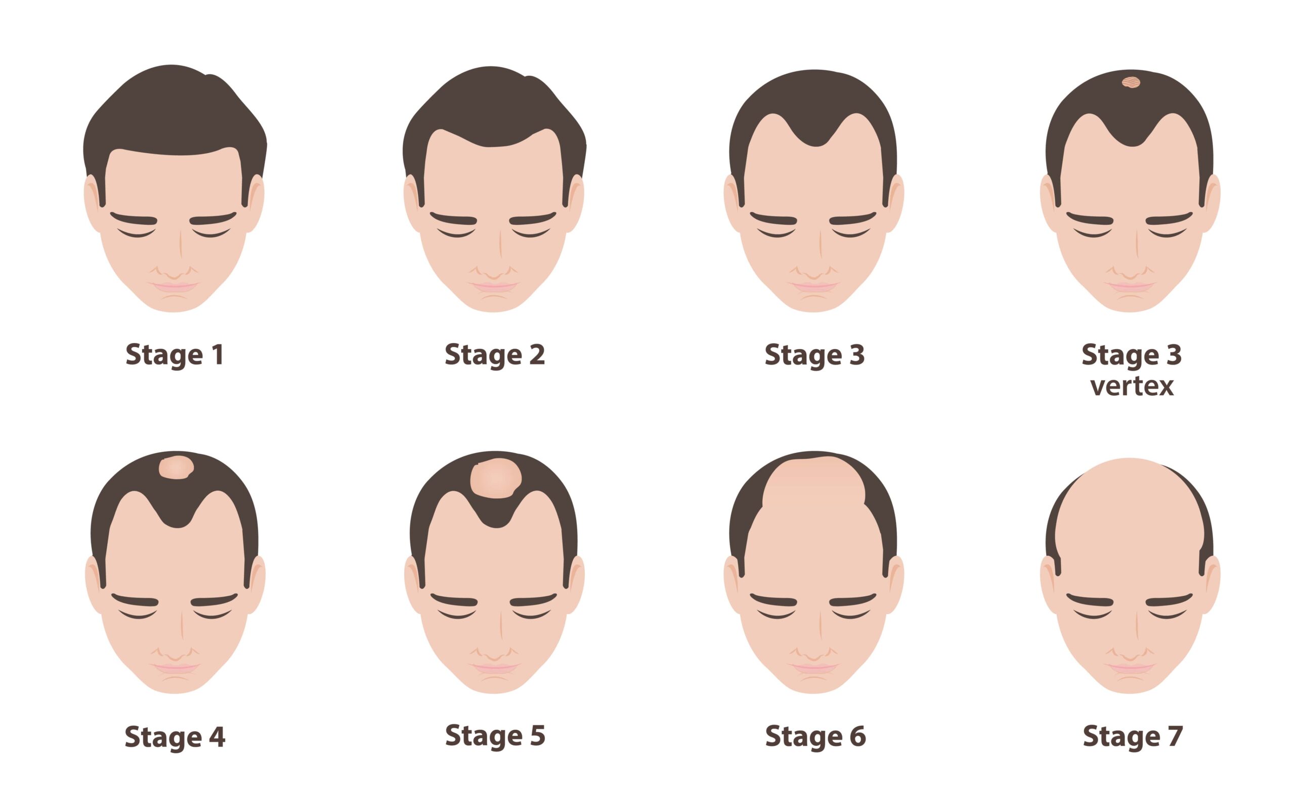 Image of the 7 stages of the norwood hamilton scale