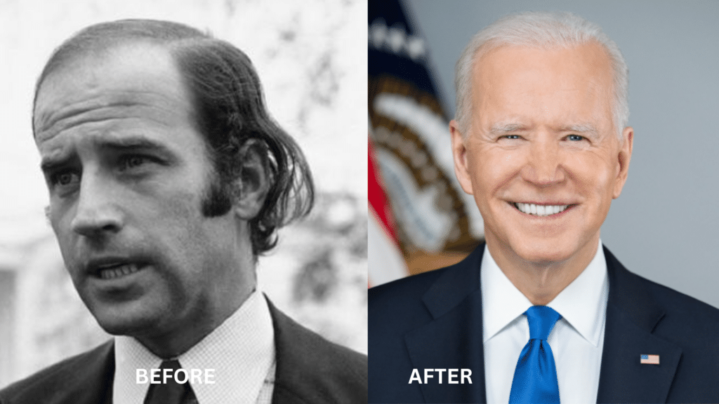 Joe Biden before and after a hair transplant