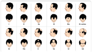 The Modern Norwood Hamilton Scale showing norwood scale 5 hair loss
