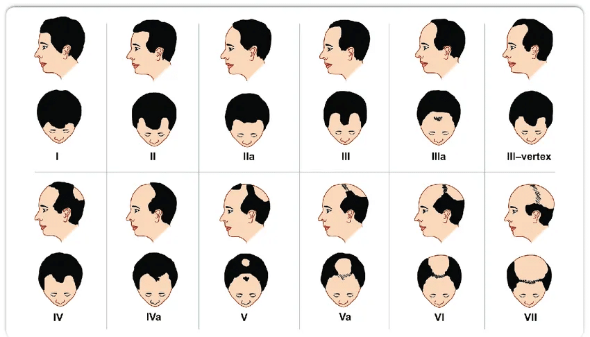 The Modern Norwood Hamilton Scale