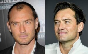 Did Jude Law get a hair transplant?