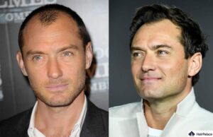 Czy Jude Law poddał się przeszczepowi włosów?