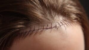 Detailopname van een genezend chirurgisch litteken op de hoofdhuid na een haartransplantatie in een kliniek.