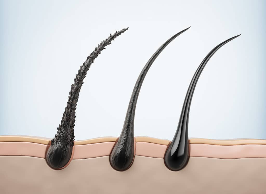 Rappresentazione grafica del danno al cuoio capelluto