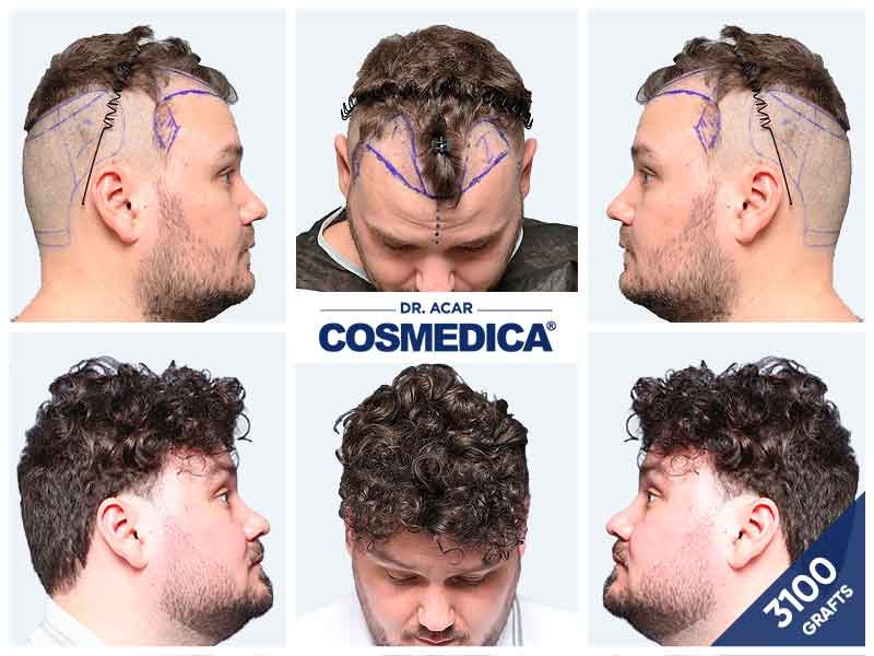 Greffe de cheveux 3000 greffons montrant une amélioration nette de la densité