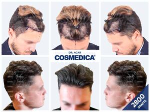 Haartransplantatie 2000 grafts met zichtbare verbetering in haardichtheid