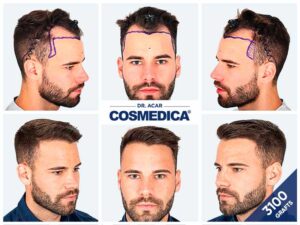 Picture showing how much hair can 3000 grafts cover