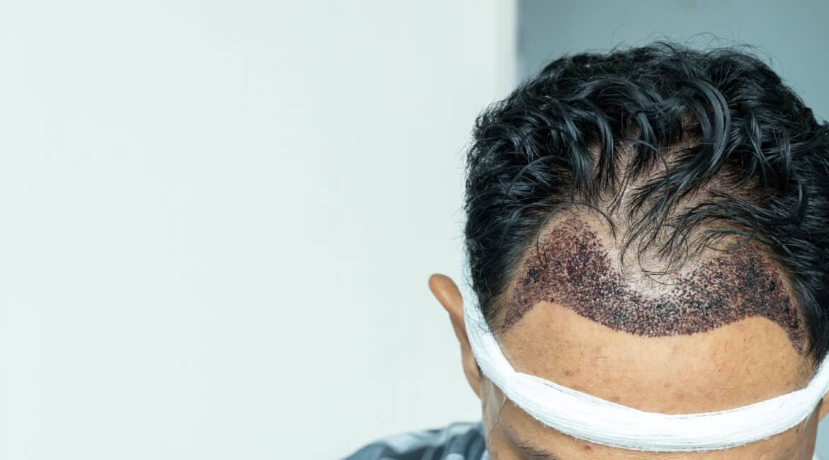 Man head with hair transplant surgery with receding hair line