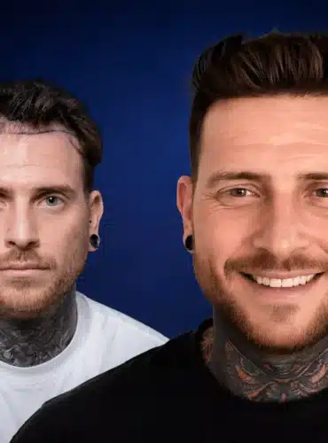 3900-grafts-hair-transplant-before-and-after-adam-m-cosmedica-6a043448c4990